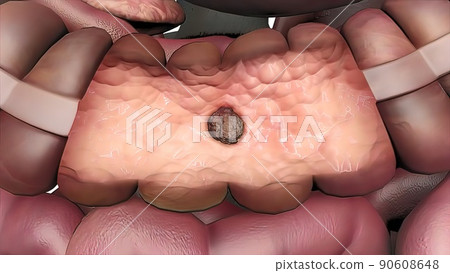 Effects of colon cancer on liver. 3D Medical 90608648