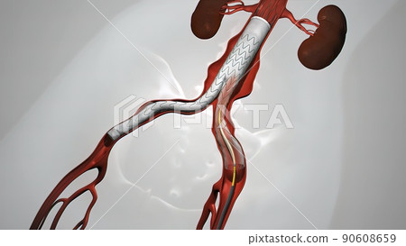balloon angioplasty procedure with stent in vein balloon angioplasty procedure with stent in vein 90608659
