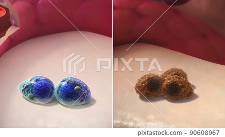 Multiple Myeloma, a type of cancer that consists of white blood cells and its spread Multiple Myeloma, a type of cancer that consists of white blood cells and its spread 90608967