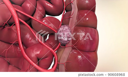 3D Medical of colon cancer. Tumor growth 90608968