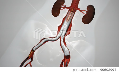balloon angioplasty procedure with stent in vein 90608991
