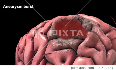 Cerebral hemorrhage as a result of an aneurysm bursting in the brain Cerebral hemorrhage as a result of an aneurysm bursting in the brain 90609225