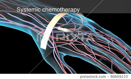 Chemotherapy is applied to the tumor areas and the tumor is cleared. 90609233