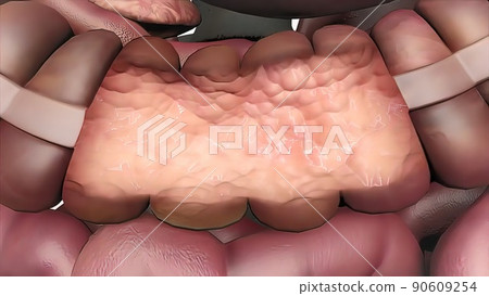 Effects of colon cancer on liver. 3D Medical 90609254