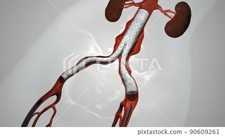 balloon angioplasty procedure with stent in vein balloon angioplasty procedure with stent in vein 90609261