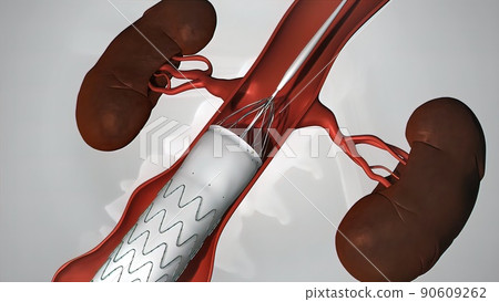 balloon angioplasty procedure with stent in vein balloon angioplasty procedure with stent in vein 90609262