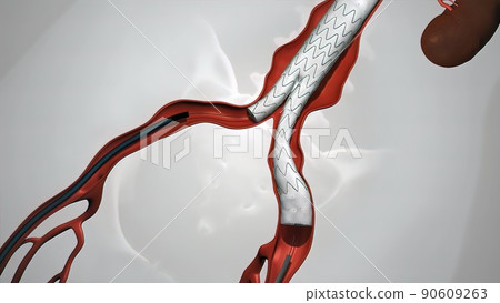 balloon angioplasty procedure with stent in vein balloon angioplasty procedure with stent in vein 90609263