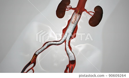 balloon angioplasty procedure with stent in vein 90609264