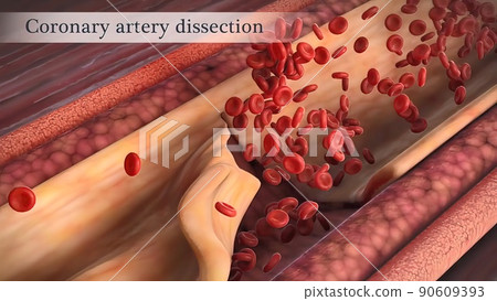 Coronary artery spasm is a brief, sudden narrowing of one of these arteries. Coronary artery spasm is a brief, sudden narrowing of one of these arteries. 90609393