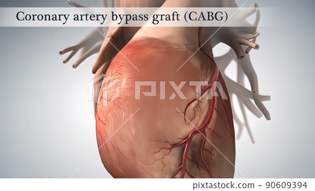 Coronary artery bypass surgery is done using a healthy blood vessel called a graft. Coronary artery bypass surgery is done using a healthy blood vessel called a graft. 90609394