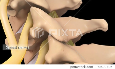 Anatomical view of the cervical spine with intervertebral disc-compressive nerve root prolapse 90609406