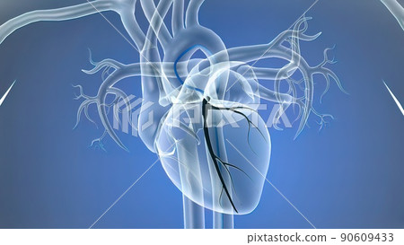 Opening the occluded artery by inserting a stent 90609433
