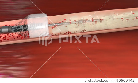 Vascular occlusion is a blockage of a blood vessel, usually with a clot. 90609442