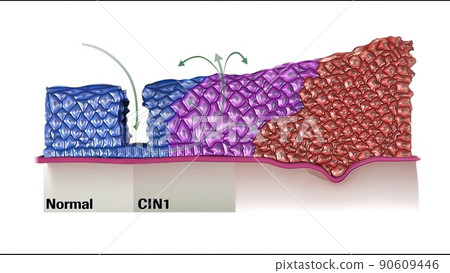 Cancer papilloma virus components 90609446