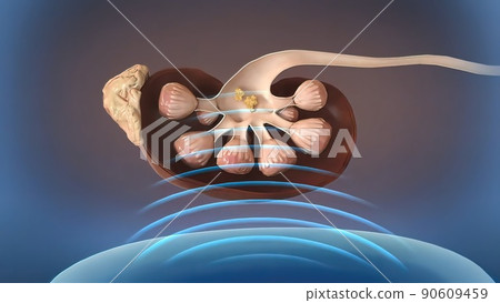 Kidney lithotripsy procedure Etracorporeal shock wave lithotripsy for remove Kidney lithotripsy procedure Etracorporeal shock wave lithotripsy for remove 90609459