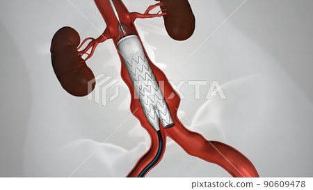 balloon angioplasty procedure with stent in vein balloon angioplasty procedure with stent in vein 90609478