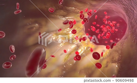 Clogging of the arteries with plaque Clogging of the arteries with plaque 90609498