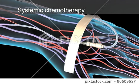 Chemotherapy is applied to the tumor areas and the tumor is cleared. Chemotherapy is applied to the tumor areas and the tumor is cleared. 90609657