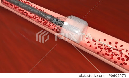 Vascular occlusion is a blockage of a blood vessel, usually with a clot. 90609673