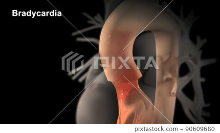 Bradycardia: This means a slow heartbeat - resting heart rate of less than 60 beats per minute Bradycardia: This means a slow heartbeat - resting heart rate of less than 60 beats per minute 90609680
