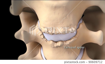 Removing the damaged disc and replacing it with metal discs 90609712