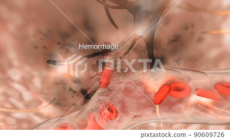 Cerebral hemorrhage as a result of an aneurysm bursting in the brain Cerebral hemorrhage as a result of an aneurysm bursting in the brain 90609726
