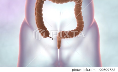 Colon during a enteroscopy with a intestinal or bowel cancer tumor visible. Colon during a enteroscopy with a intestinal or bowel cancer tumor visible. 90609728