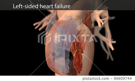 illustration Congestive Heart Failure illustration Congestive Heart Failure 90609744