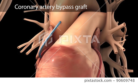 Coronary artery bypass surgery is done using a healthy blood vessel called a graft. Coronary artery bypass surgery is done using a healthy blood vessel called a graft. 90609748