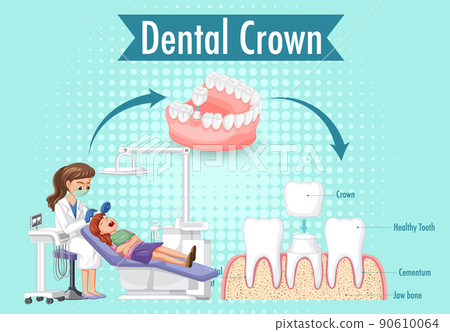 Infographic of human in dental crown 90610064