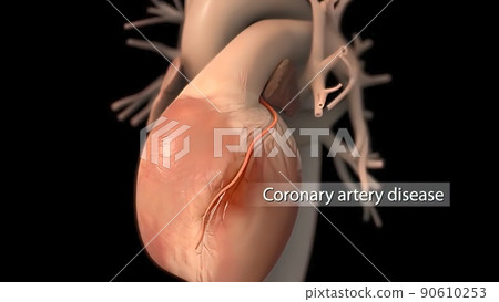 Carotid Artery Disease 3D Medical illustration 90610253