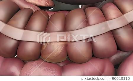 Effects of colon cancer on liver. 3D Medical 90610310