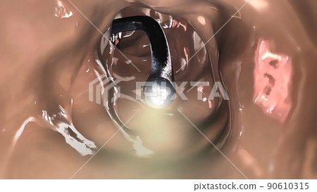 Colonoscopy Biopsy Of The Gastrointestinal Tract In Patients 90610315