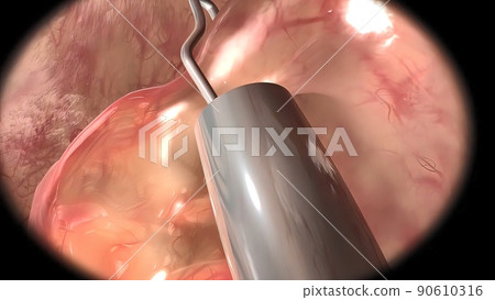 The tumor cell is cut out with a hook The tumor cell is cut out with a hook 90610316