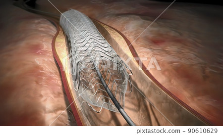 Hemoglobin cells flowing through a blocked Artery causing arteriosclerosis disease. 90610629