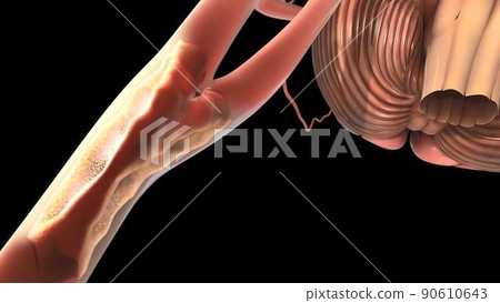 The vein to the brain is blocked and brain hemorrhage occurs 90610643