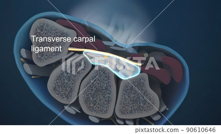 Carpal tunnel syndrome is when the median nerve is compressed as it passes through the carpal tunnel 90610646