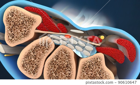 Carpal tunnel syndrome (CTS), numbness, tingling and pain condition in wrist Carpal tunnel syndrome (CTS), numbness, tingling and pain condition in wrist 90610647