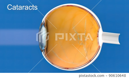 Cataract, clouding of the lens of the eye that causes decreased vision. Cataract, clouding of the lens of the eye that causes decreased vision. 90610648