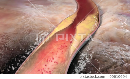 Clogging of the arteries with plaque Clogging of the arteries with plaque 90610694