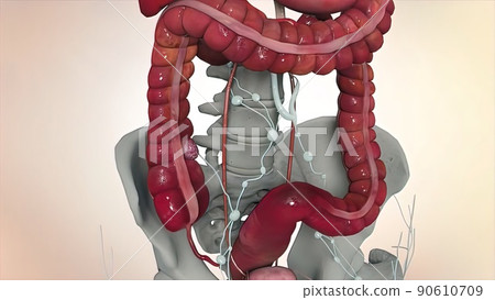 Colon during a enteroscopy with a intestinal or bowel cancer tumor visible. Colon during a enteroscopy with a intestinal or bowel cancer tumor visible. 90610709