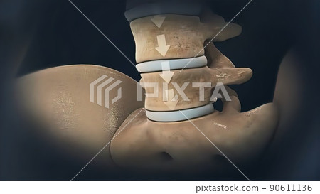 Compression of the disc Arthritis Effects On The Spine 90611136