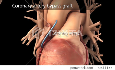 Coronary artery bypass surgery is done using a healthy blood vessel called a graft. Coronary artery bypass surgery is done using a healthy blood vessel called a graft. 90611137