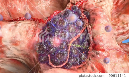 Division and growth of cancerous cells 90611141