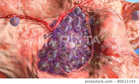 Stages of Tumor Development. 3D Medical 90611143