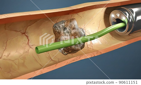 Kidney Stone Treatment. Lithotripsy. Kidney Stone Treatment. Lithotripsy. 90611151