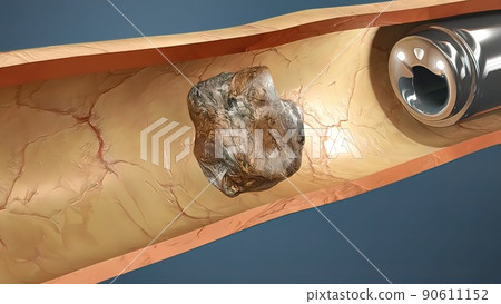 Kidney Stone Treatment. Lithotripsy. Kidney Stone Treatment. Lithotripsy. 90611152