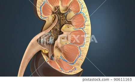 Kidney Stone Treatment. Lithotripsy. Kidney Stone Treatment. Lithotripsy. 90611163