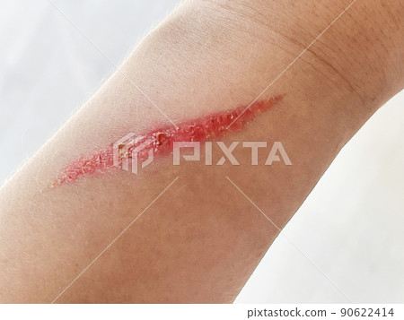 Close up of burn scar on a woman's hand. The skin damage in first-degree on outer layer skin. Close up of burn scar on a woman's hand. The skin damage in first-degree on outer layer skin. 90622414