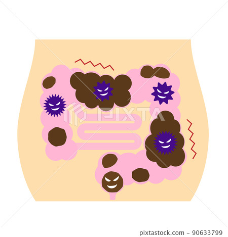 Image of constipation. A poop that collects in an unhealthy intestine. 90633799